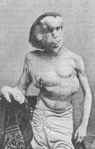 Joseph Merrick