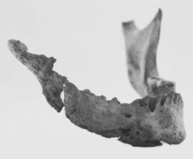 Phossy Jaw